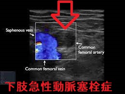 下肢急性動脈塞栓症 下肢超音波(エコー)画像