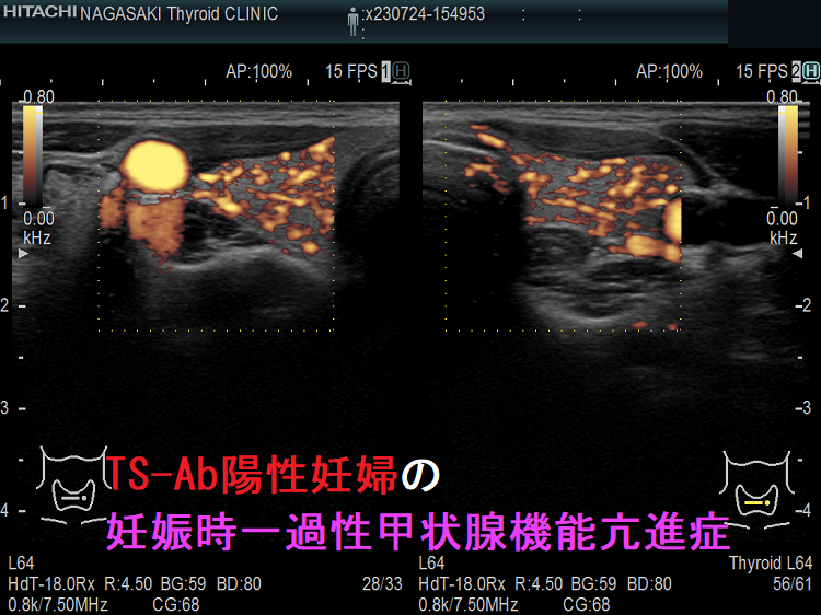 TS-Ab陽性妊婦の妊娠時一過性甲状腺機能亢進症 ドプラーモード