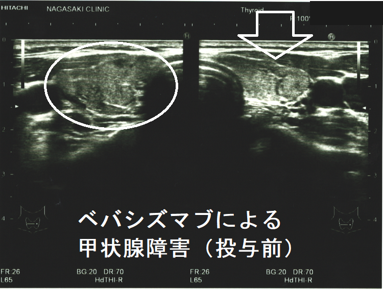 ベバシズマブによる甲状腺障害 投与前 超音波(エコー)画像