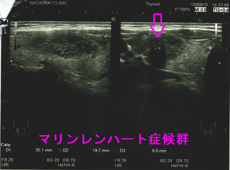 甲状腺乳頭癌によるマリンレンハート症候群 超音波(エコー)画像