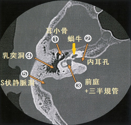 右側頭骨CT画像