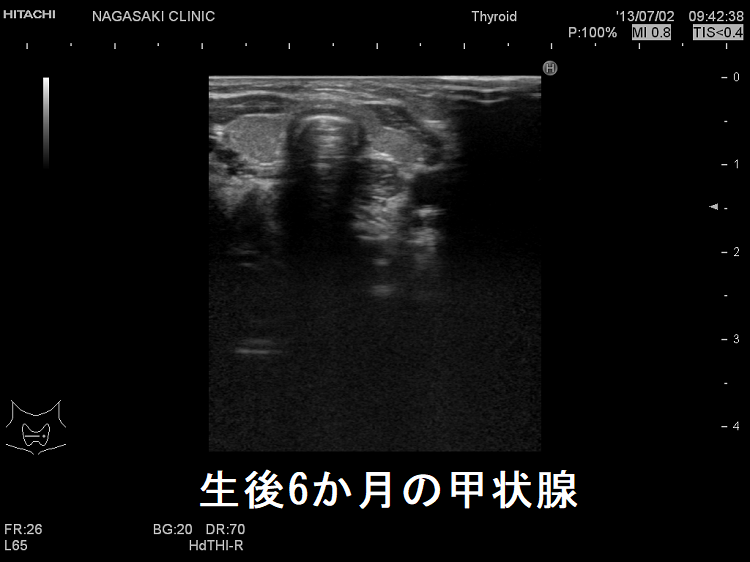 生後6か月の甲状腺　超音波(エコー)画像