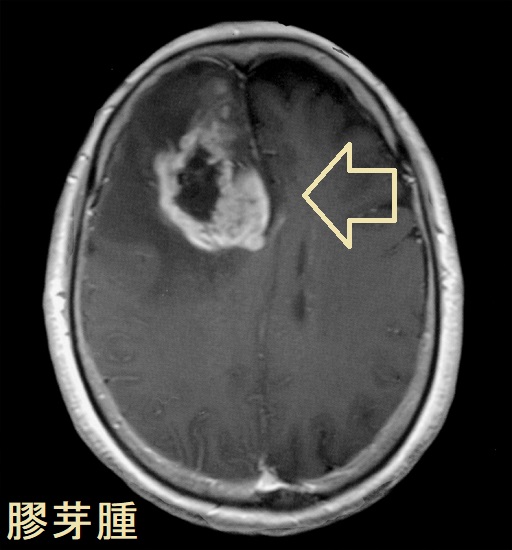 膠芽腫 造影MRI