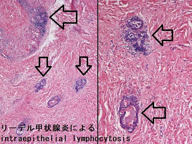リーデル甲状腺炎によるintraepithelial lymphocytosis (UC, San Diego medpics)