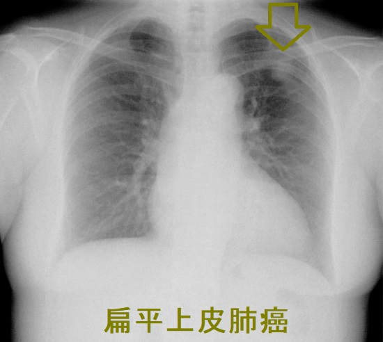 扁平上皮肺癌（末梢肺癌） 胸部エックス線写真