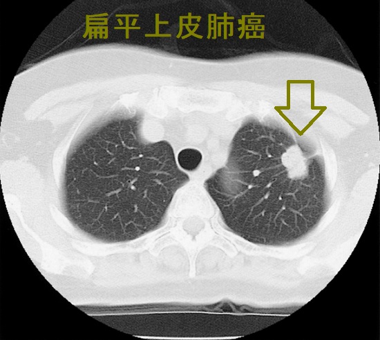 扁平上皮肺癌（末梢肺癌） 胸部CT画像