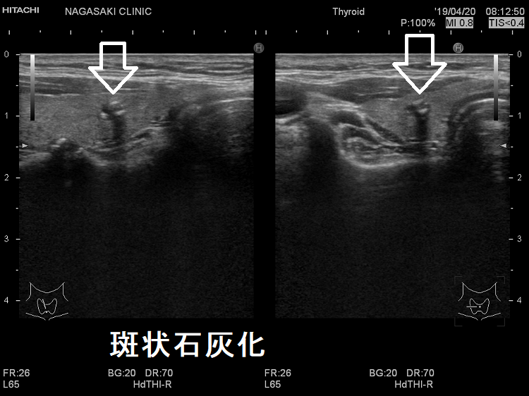 甲状腺微小乳頭癌 超音波(エコー)画像；斑状石灰化