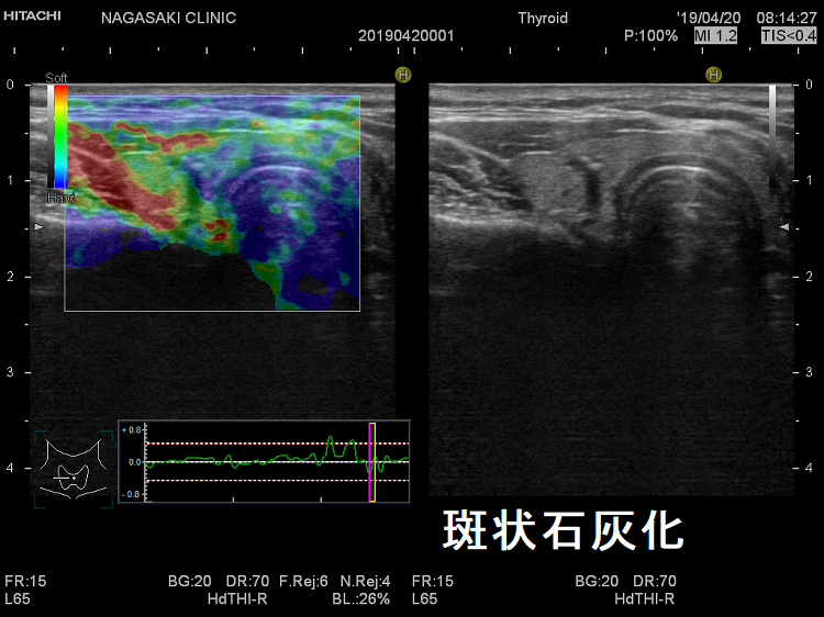 甲状腺微小乳頭癌 超音波(エコー)画像；斑状石灰化 エラストグラフィー