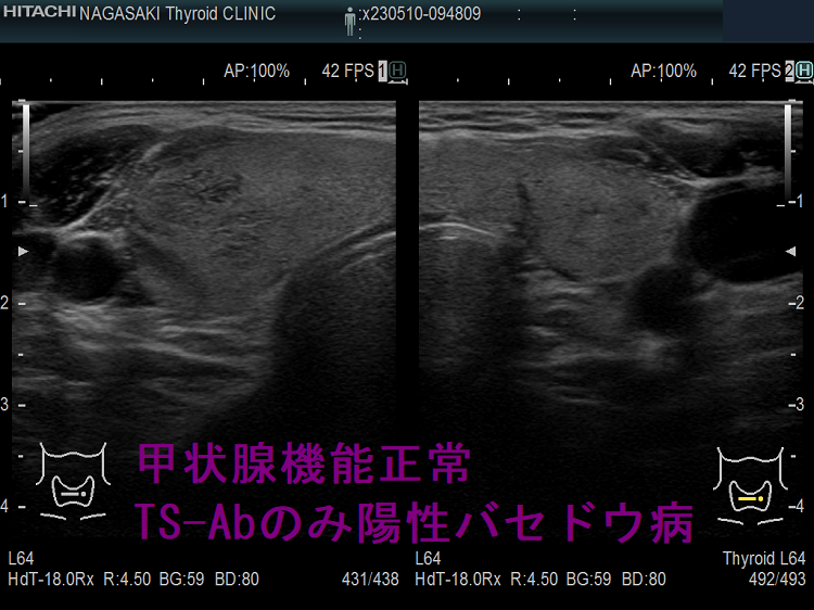 甲状腺機能正常　TS-Abのみ陽性バセドウ病　超音波(エコー)画像