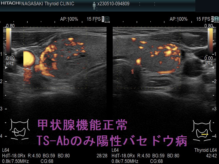甲状腺機能正常　TS-Abのみ陽性バセドウ病　超音波(エコー)画像　ドプラーモード