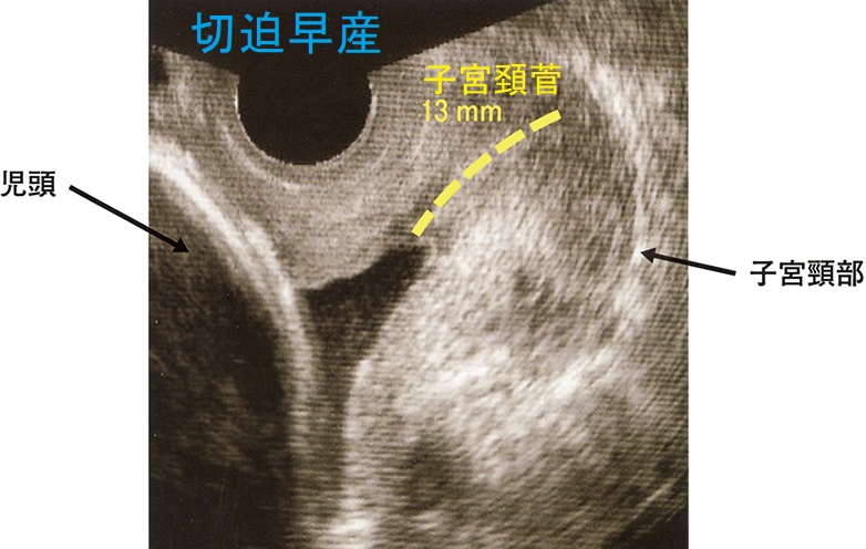 切迫早産 経腟超音波（エコー）検査