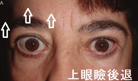 バセドウ病眼症(甲状腺眼症) 上眼瞼後退