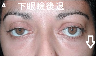 バセドウ病眼症(甲状腺眼症) 下眼瞼後退