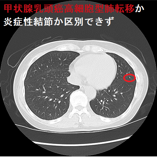 甲状腺乳頭癌高細胞型肺転移か炎症性結節か区別できず(CT画像)3