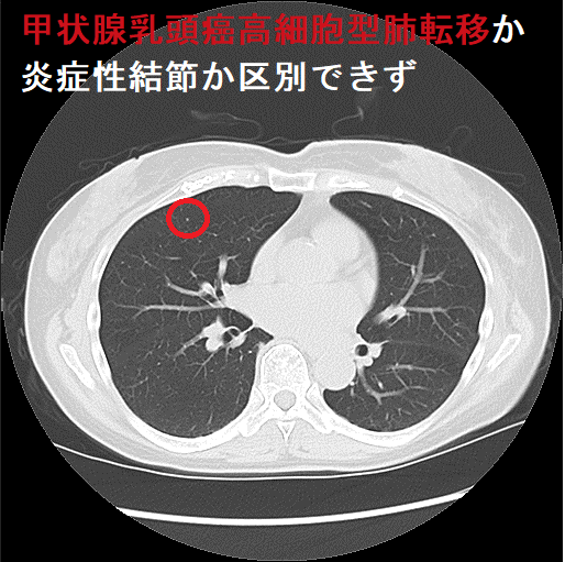 甲状腺乳頭癌高細胞型肺転移か炎症性結節か区別できず(CT画像)2