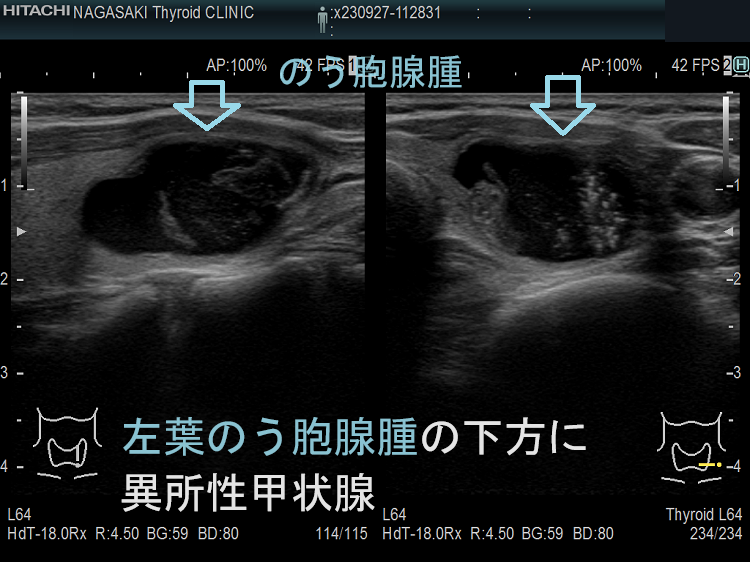 左葉のう胞腺腫の下方にある頚部異所性甲状腺(非腫瘍)