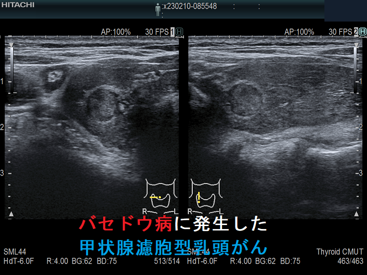 バセドウ病と腫瘍・癌