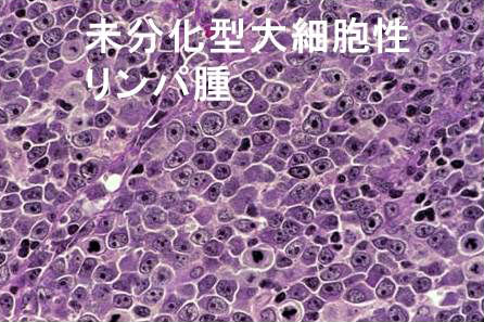 未分化大細胞性リンパ腫