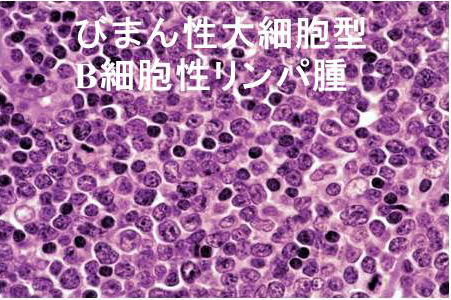 びまん性大細胞型Bリンパ腫（DLBCL） 組織診