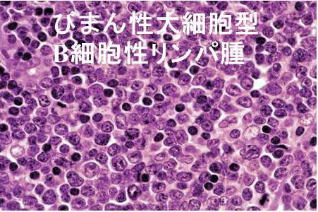 大 リンパ腫 型 びまん b 細胞 性 細胞 非移植適応再発難治性びまん性大細胞型B細胞リンパ腫患者に対するポラツズマブ ベドチン＋トレアキシン＋リツキサン、完全奏効率を有意に改善