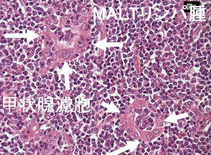 MALTリンパ腫のMALT ball