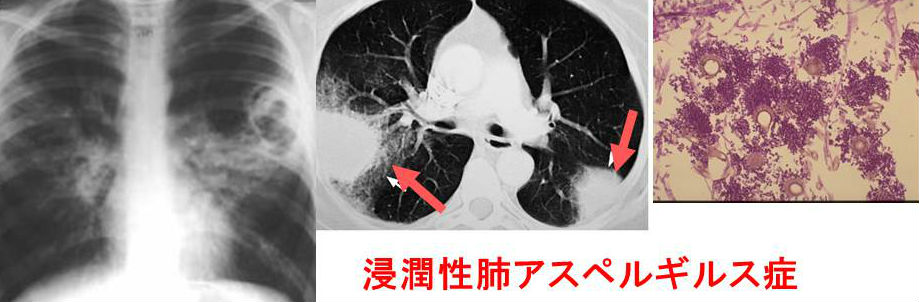 侵襲性肺アスペルギルス症