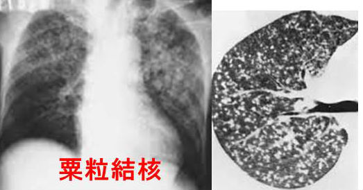 結核と甲状腺、粟粒結核・脊椎カリエス [橋本病 バセドウ病 甲状腺超音波(エコー)検査 甲状腺機能低下症 長崎甲状腺クリニック(大阪)]