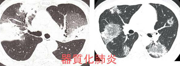 甲状腺癌肺転移で起こる器質化肺炎