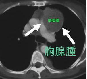 胸腺腫 CT画像
