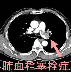 肺血栓塞栓症 造影CT画像