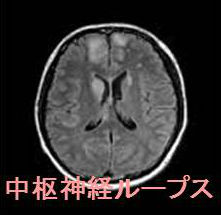 中枢神経ループス MRI画像
