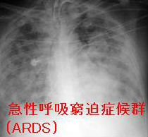 急性呼吸窮迫（こきゅうひっぱく）症候群（ARDS）