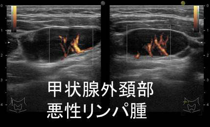 甲状腺外 頚部悪性リンパ腫 超音波(エコー)画像