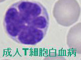 成人T細胞白血病