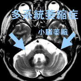 多系統萎縮症 MRI画像