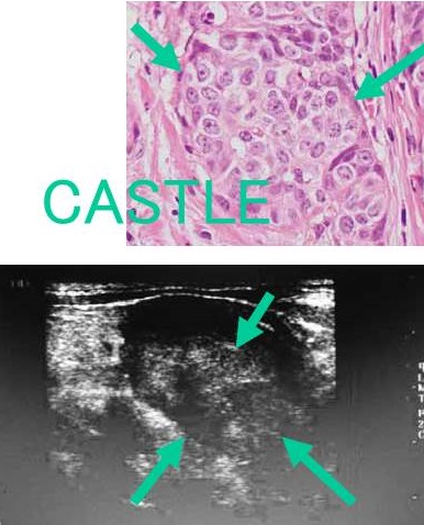 CASTLE甲状腺癌 病理組織 超音波(エコー)画像
