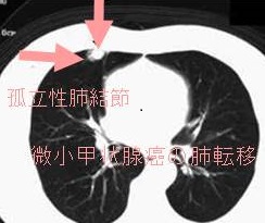 浸潤型微小乳頭癌の肺転移