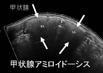 甲状腺アミロイドーシス 超音波(エコー)画像