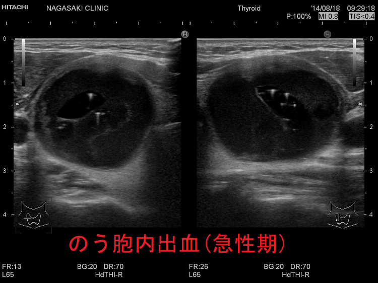 亜急性甲状腺炎の症状は何ですか?