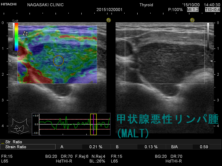 甲状腺原発悪性リンパ腫(MALT)超音波（エコー）画像：エラストグラフィー