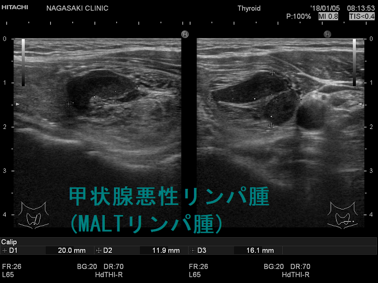 甲状腺悪性リンパ腫(MALTリンパ腫)  超音波（エコー）画像
