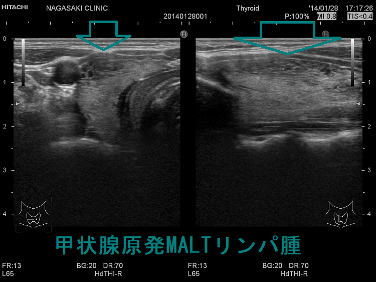 甲状腺原発MALTリンパ腫 超音波（エコー）画像