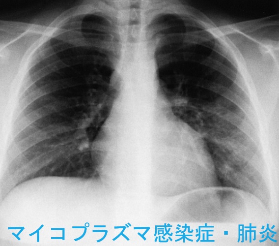 マイコプラズマ感染症・肺炎　胸部レントゲン画像