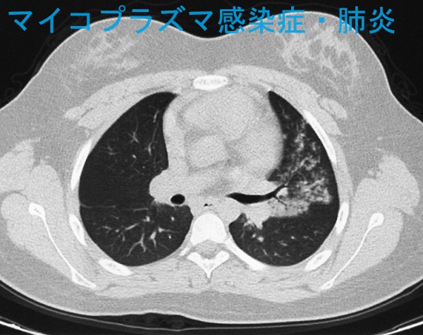 マイコプラズマ感染症・肺炎　CT画像
