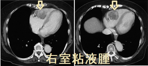 右室粘液腫 胸部造影CT 縦隔条件