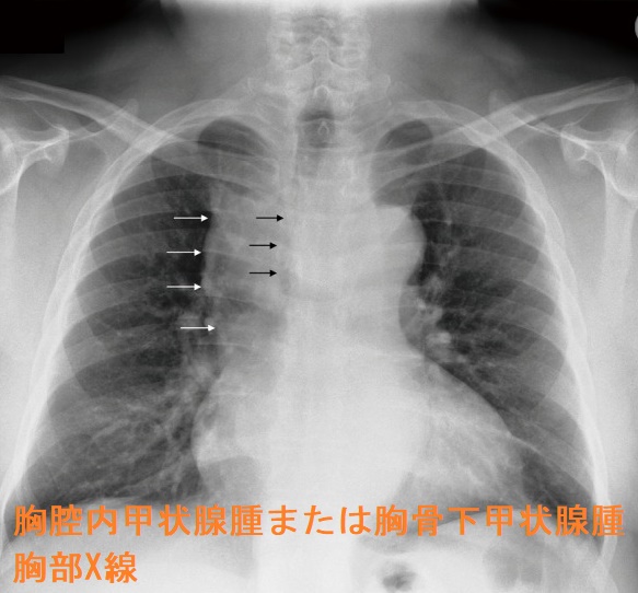 胸腔内甲状腺腫または胸骨下甲状腺腫 胸部X線 胸腔内甲状腺腫または胸骨下甲状腺腫 胸部X線