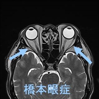橋本病眼症MRI画像