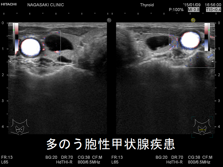 多のう胞性甲状腺疾患 超音波(エコー)画像2