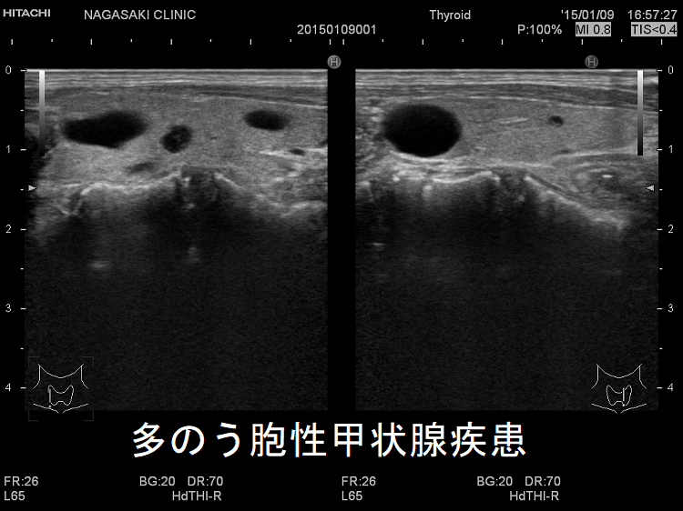 多のう胞性甲状腺疾患 超音波(エコー)画像