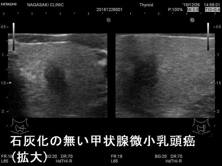 石灰化の無い甲状腺微小乳頭癌(拡大)超音波(エコー)画像
